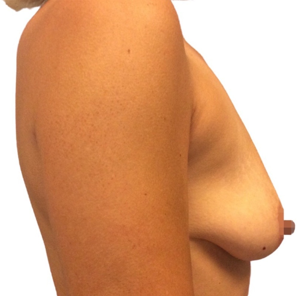 Breast Augmentation Before & After Gallery - Patient 13948298 - Image 3