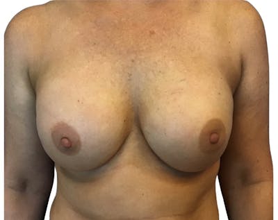Breast Augmentation Before & After Gallery - Patient 13948300 - Image 2