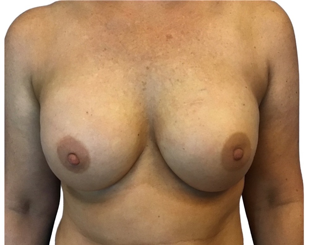 Breast Augmentation Before & After Gallery - Patient 13948300 - Image 2