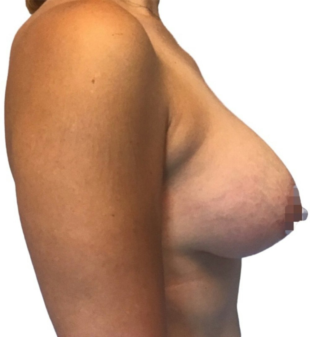 Breast Augmentation Before & After Gallery - Patient 13948298 - Image 4