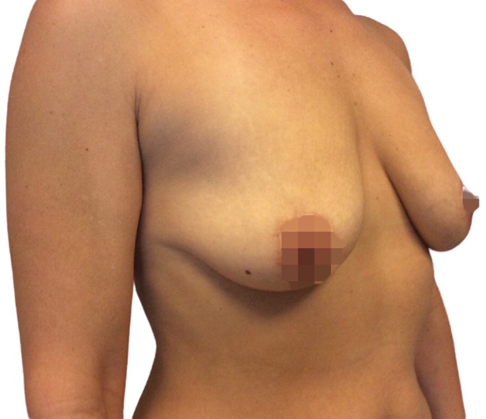 Breast Augmentation Before & After Gallery - Patient 13948298 - Image 5