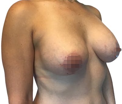Breast Augmentation Before & After Gallery - Patient 13948298 - Image 6