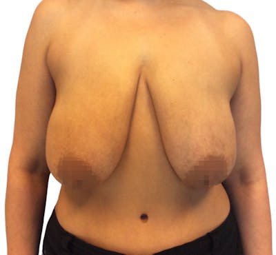 Breast Reduction Before & After Gallery - Patient 13948304 - Image 1