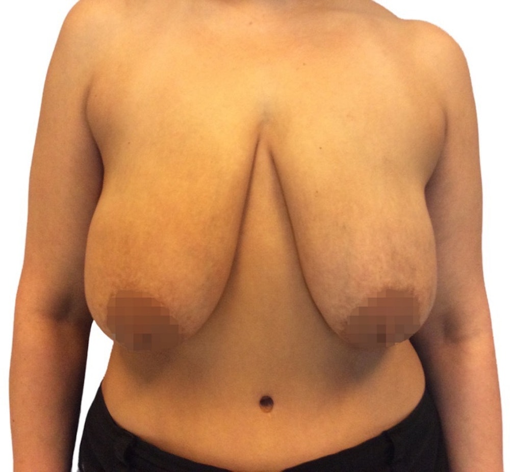 Breast Reduction Before & After Gallery - Patient 13948304 - Image 1