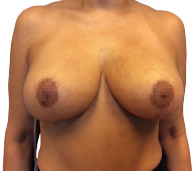 Breast Reduction Before & After Gallery - Patient 13948304 - Image 2