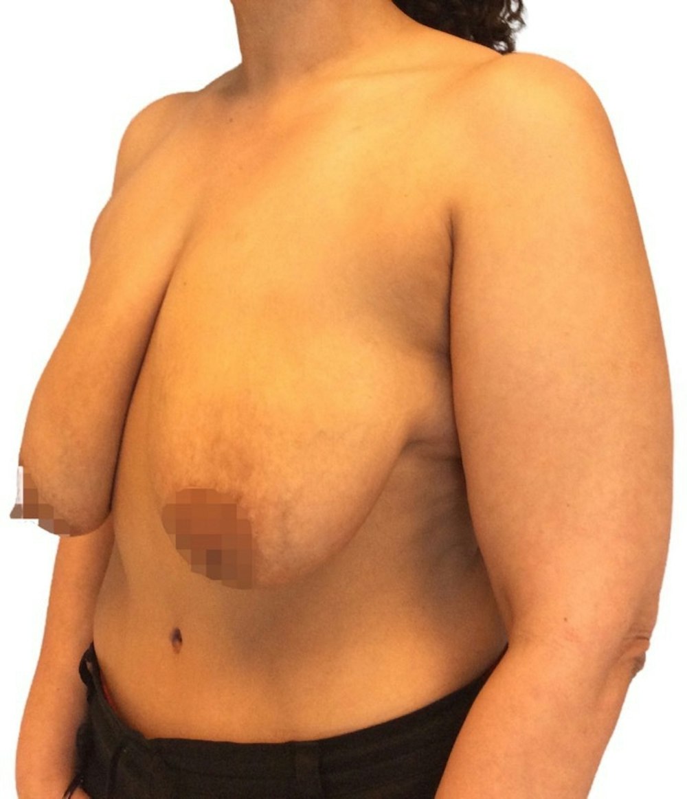 Breast Reduction Before & After Gallery - Patient 13948304 - Image 3