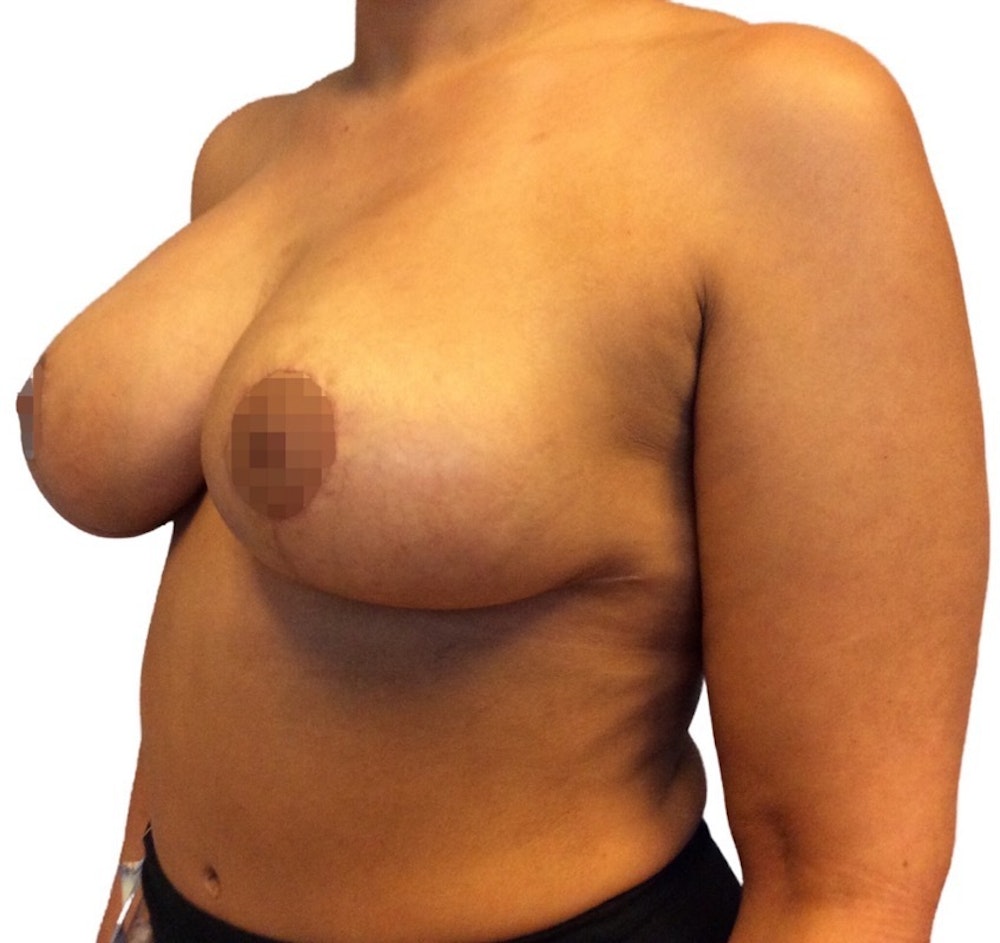 Breast Reduction Before & After Gallery - Patient 13948304 - Image 4