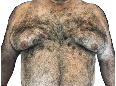 Male Breast Reduction Before & After Gallery - Patient 13948441 - Image 1