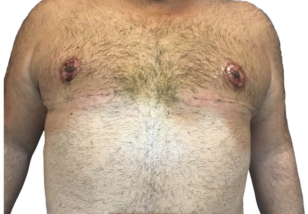 Male Breast Reduction Before & After Gallery - Patient 13948441 - Image 2
