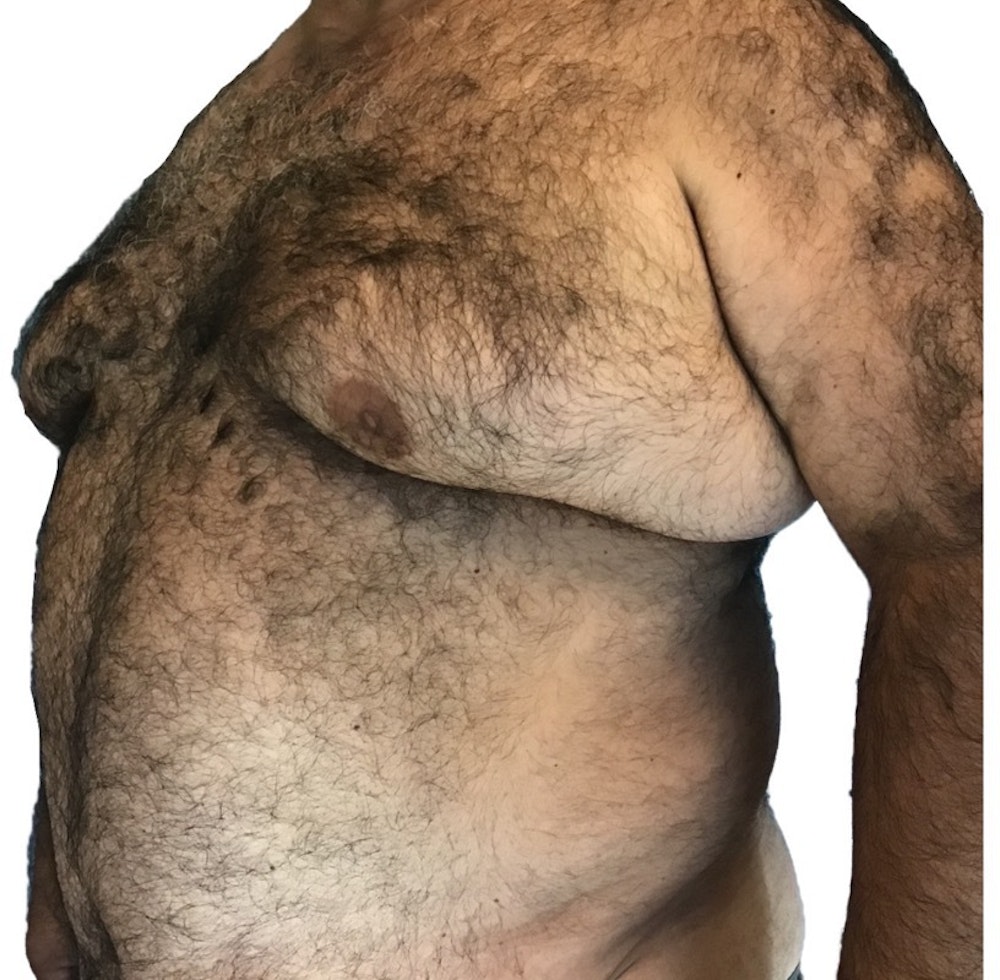 Male Breast Reduction Before & After Gallery - Patient 13948441 - Image 3