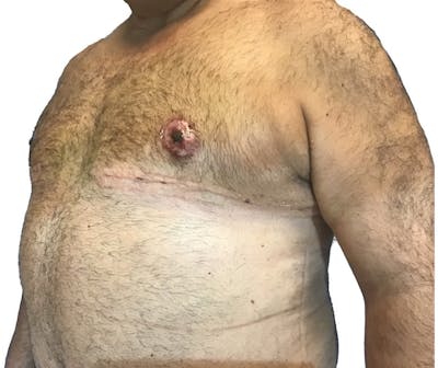 Male Breast Reduction Before & After Gallery - Patient 13948441 - Image 4