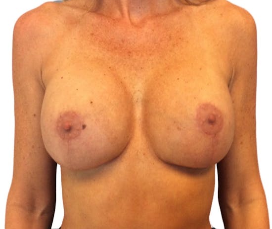 Breast Implant Revision with Dr. Anthony Admire in Scottsdale