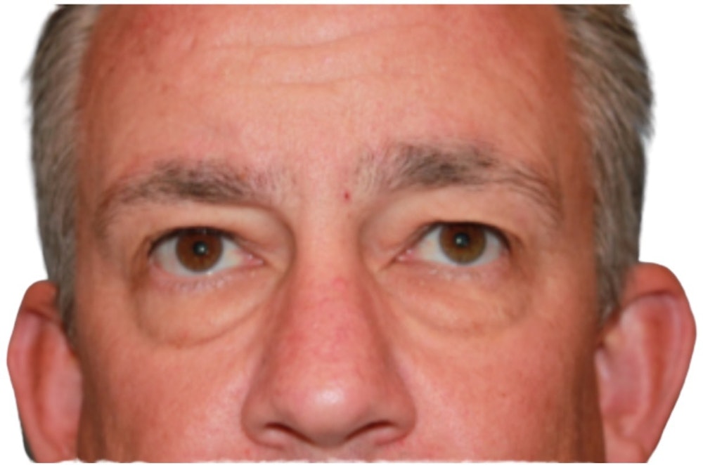 Blepharoplasty Before & After Gallery - Patient 13948446 - Image 1