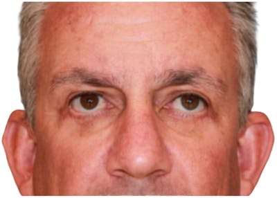 Blepharoplasty Before & After Gallery - Patient 13948446 - Image 2