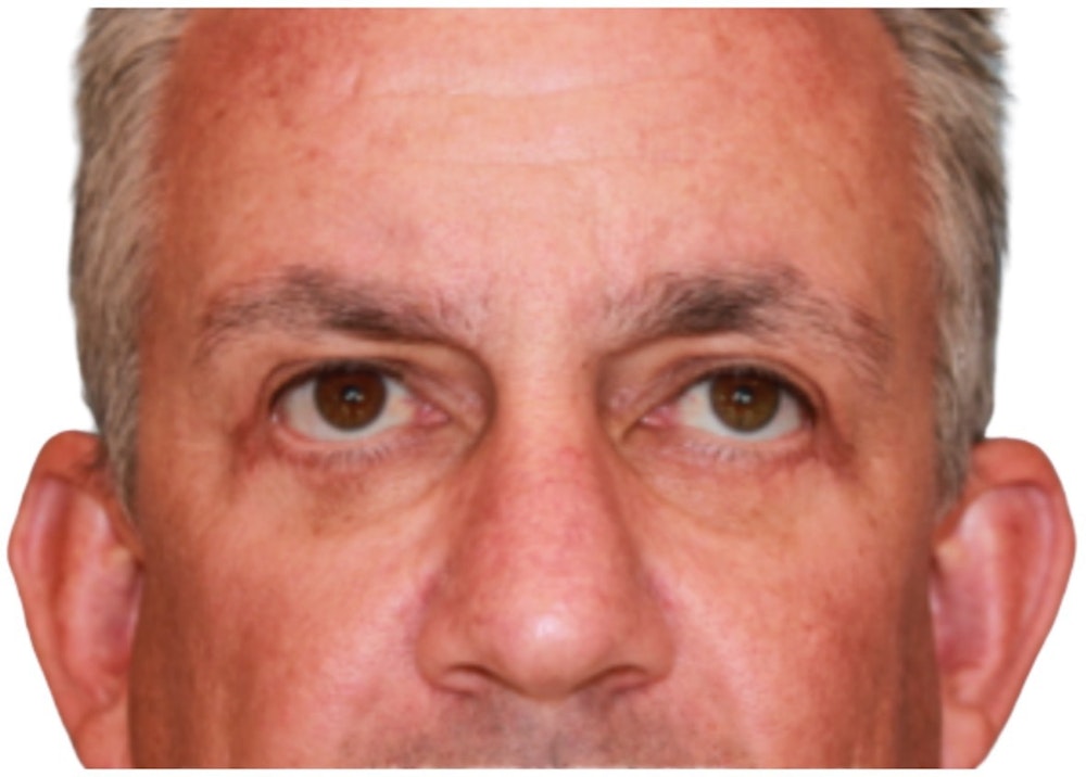 Blepharoplasty Before & After Gallery - Patient 13948446 - Image 2