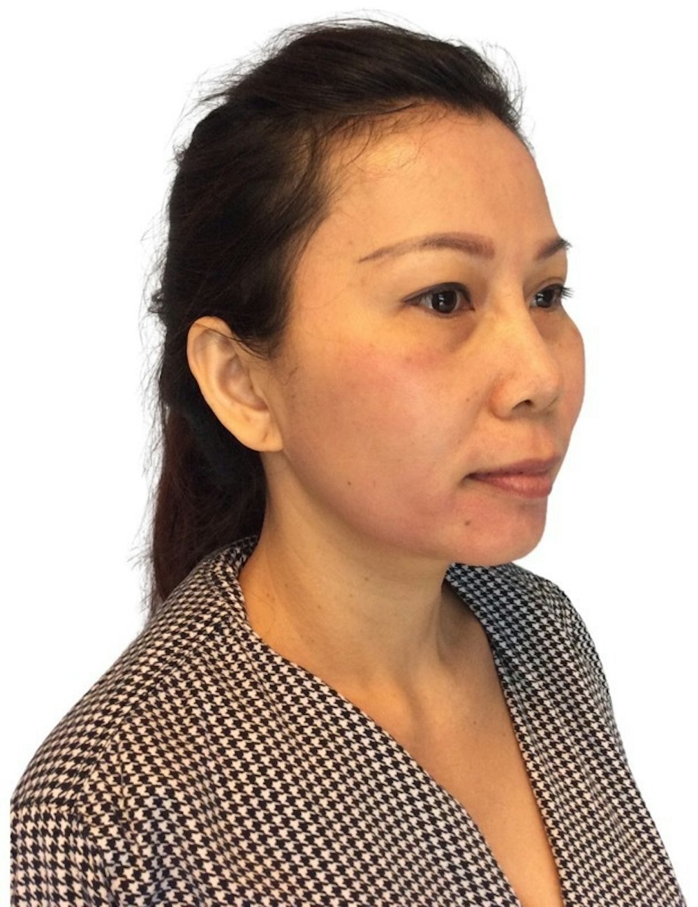 Chin Implant Before & After Gallery - Patient 13948448 - Image 3