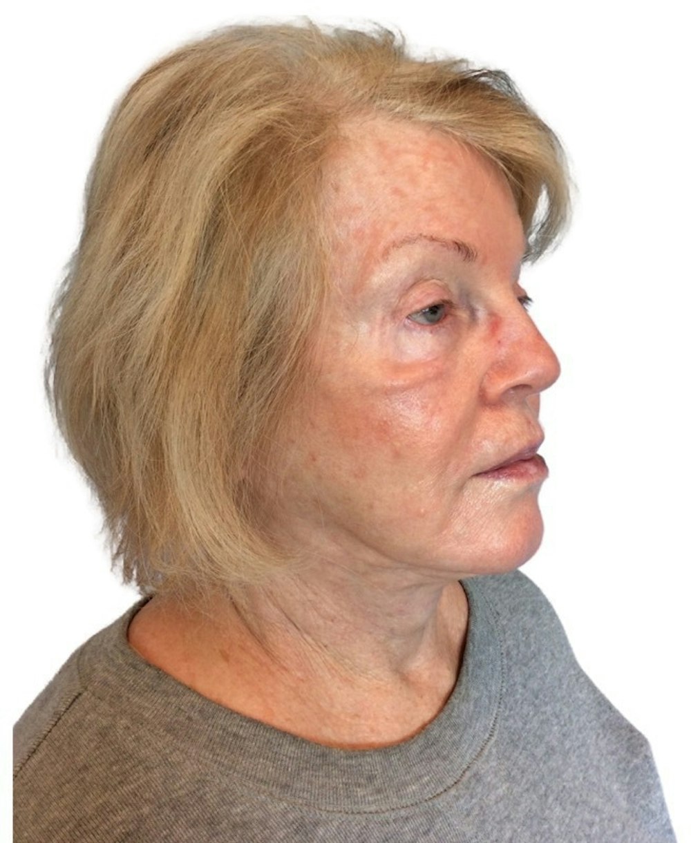 Deep Plane Facelift Before & After Gallery - Patient 13948524 - Image 1