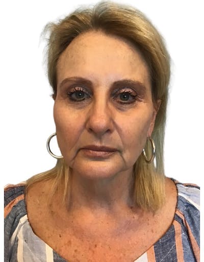 Deep Plane Facelift Before & After Gallery - Patient 13948526 - Image 1