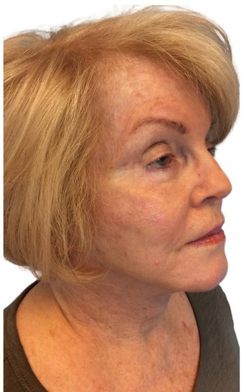 Deep Plane Facelift Before & After Gallery - Patient 13948524 - Image 2