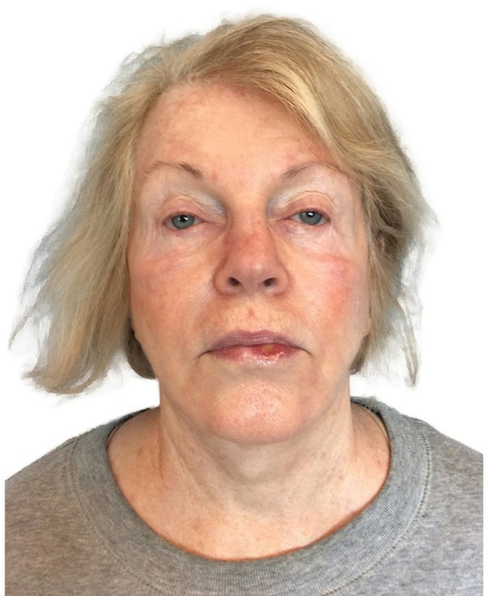 Deep Plane Facelift Before & After Gallery - Patient 13948524 - Image 3