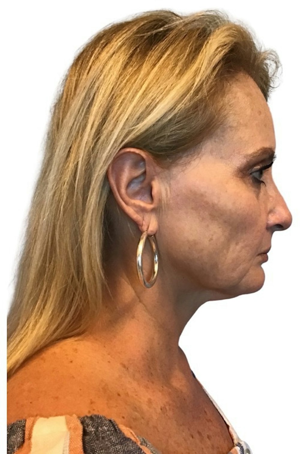 Deep Plane Facelift Before & After Gallery - Patient 13948526 - Image 3
