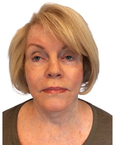 Deep Plane Facelift Before & After Gallery - Patient 13948524 - Image 4