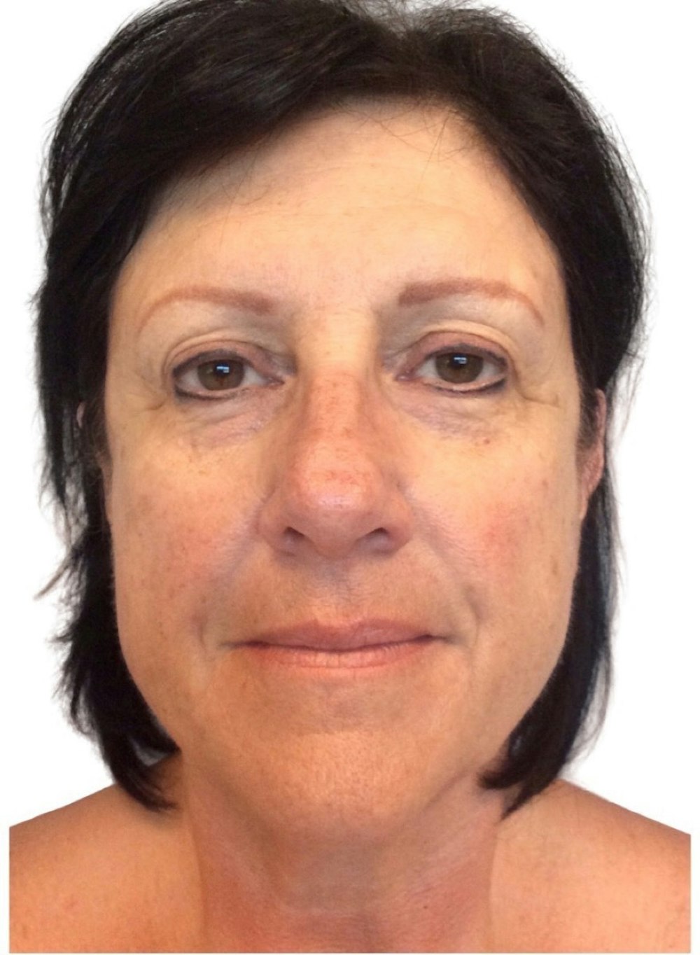 Deep Plane Facelift Before & After Gallery - Patient 13948529 - Image 1
