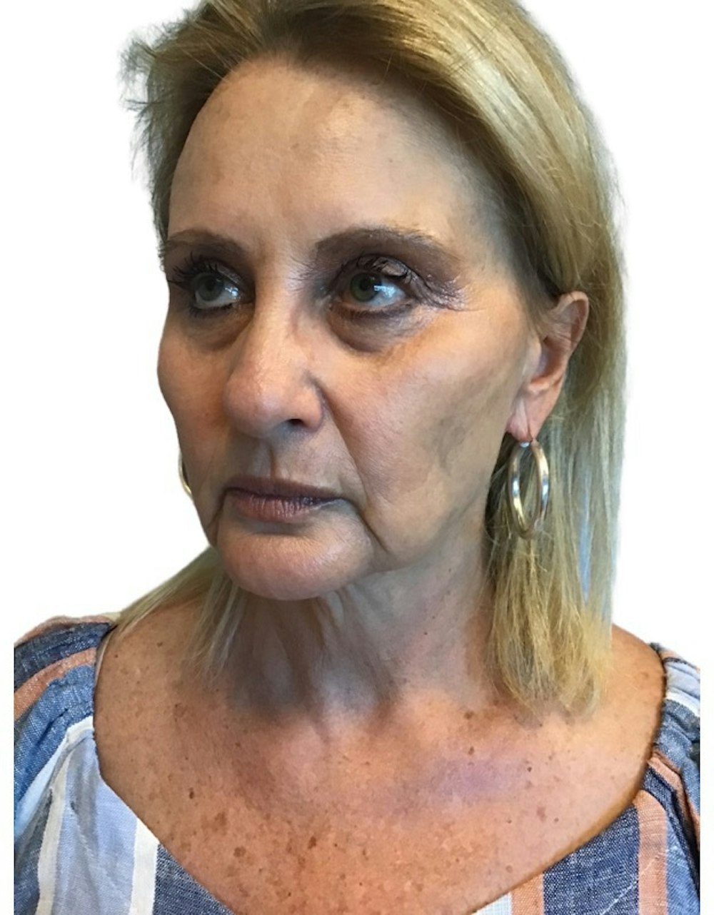Deep Plane Facelift Before & After Gallery - Patient 13948526 - Image 5
