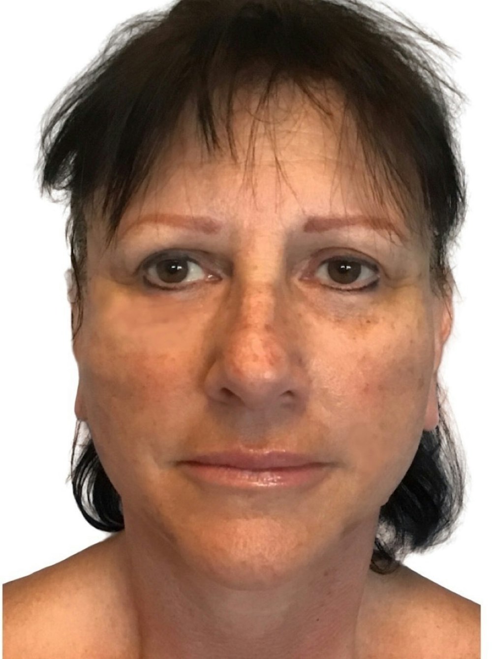Deep Plane Facelift Before & After Gallery - Patient 13948529 - Image 2