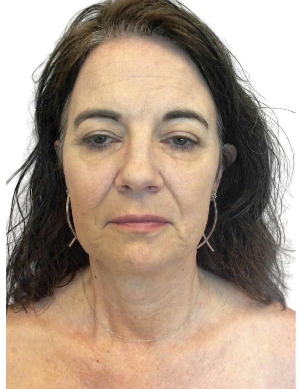 Deep Plane Facelift Before & After Gallery - Patient 13948530 - Image 1