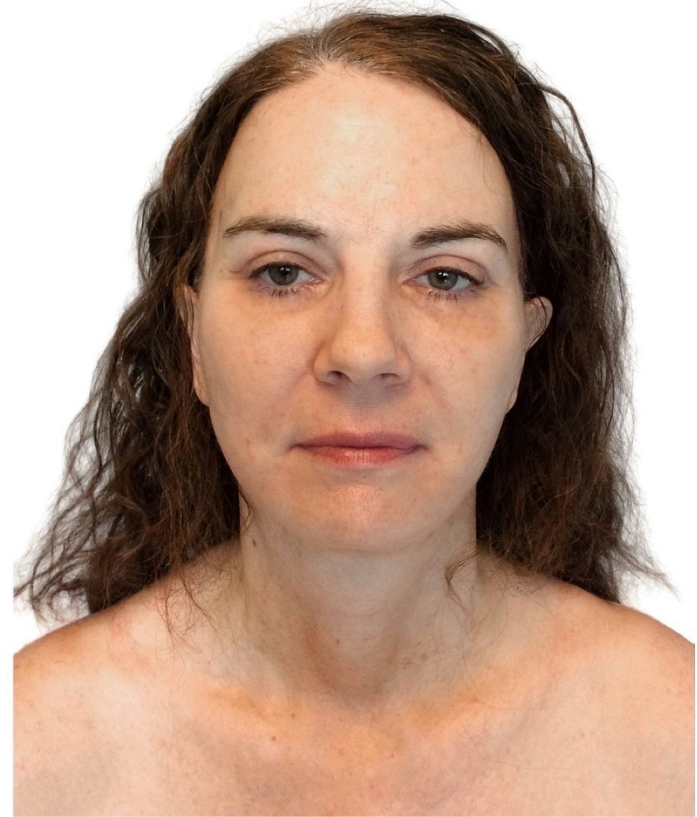 Deep Plane Facelift Before & After Gallery - Patient 13948530 - Image 2