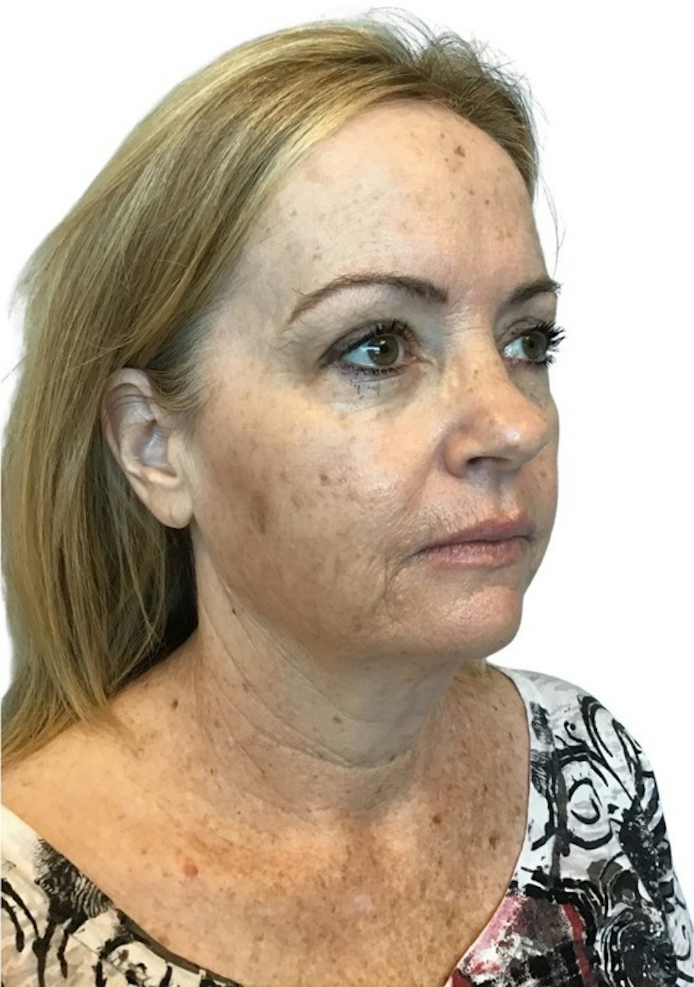 Facelift Before & After Gallery - Patient 13948531 - Image 1
