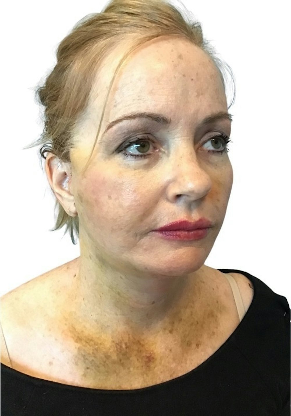 Facelift Before & After Gallery - Patient 13948531 - Image 2