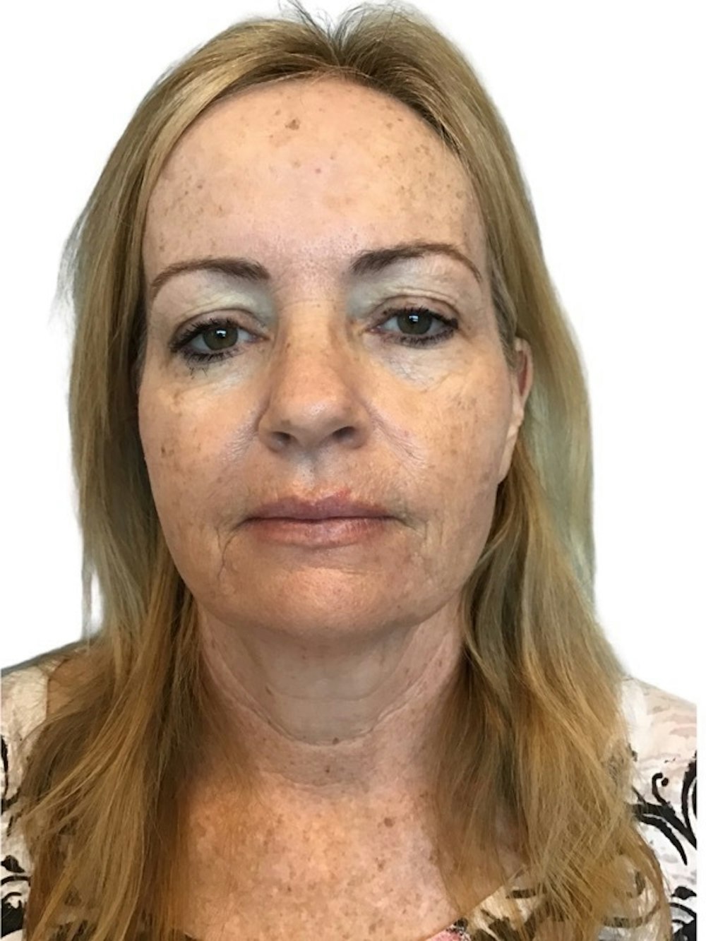 Facelift Before & After Gallery - Patient 13948531 - Image 3