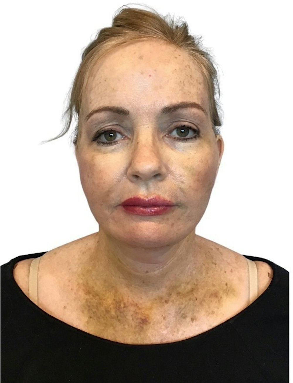Facelift Before & After Gallery - Patient 13948531 - Image 4