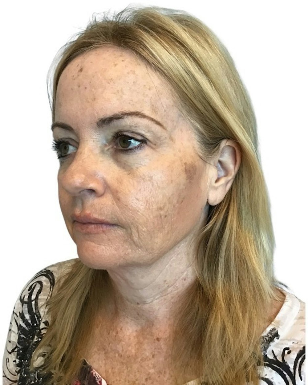 Deep Plane Facelift Before & After Gallery - Patient 13948531 - Image 5