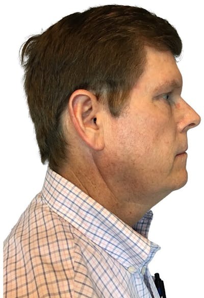 Facelift Before & After Gallery - Patient 13948533 - Image 1