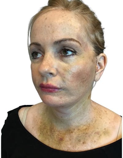 Deep Plane Facelift Before & After Gallery - Patient 13948531 - Image 6