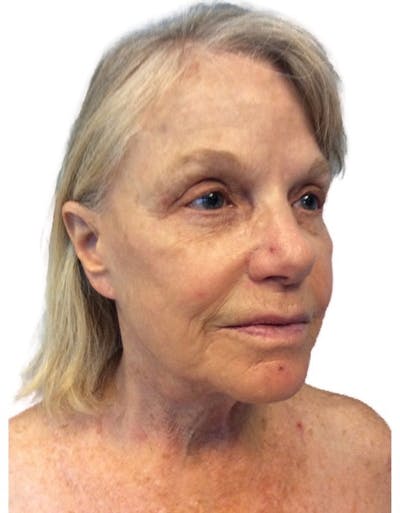 Facelift Before & After Gallery - Patient 13948534 - Image 1