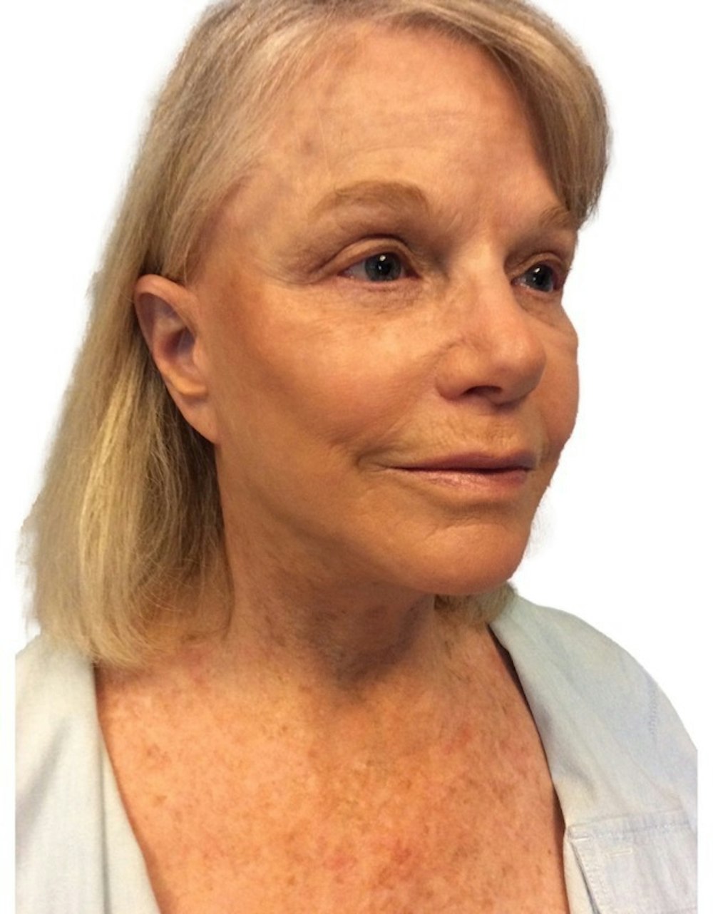 Deep Plane Facelift Before & After Gallery - Patient 13948534 - Image 2