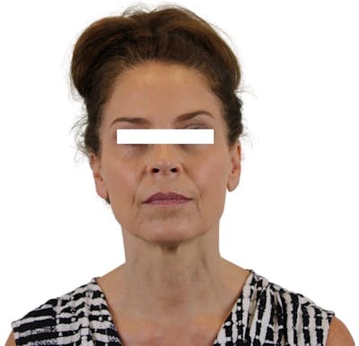 Facelift Gallery - Patient 13948536 - Image 2