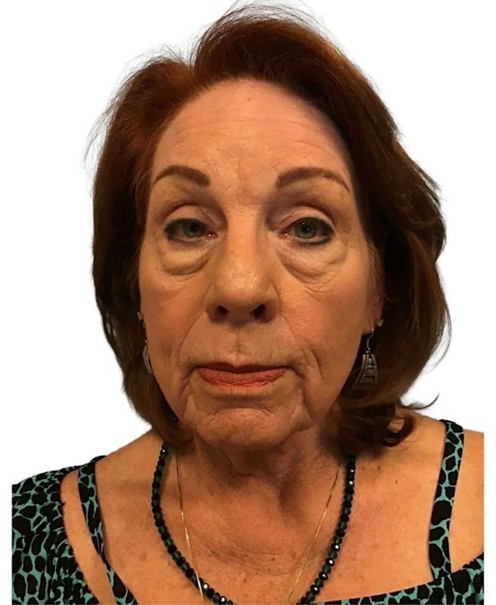 Deep Plane Facelift Before & After Gallery - Patient 13948537 - Image 1