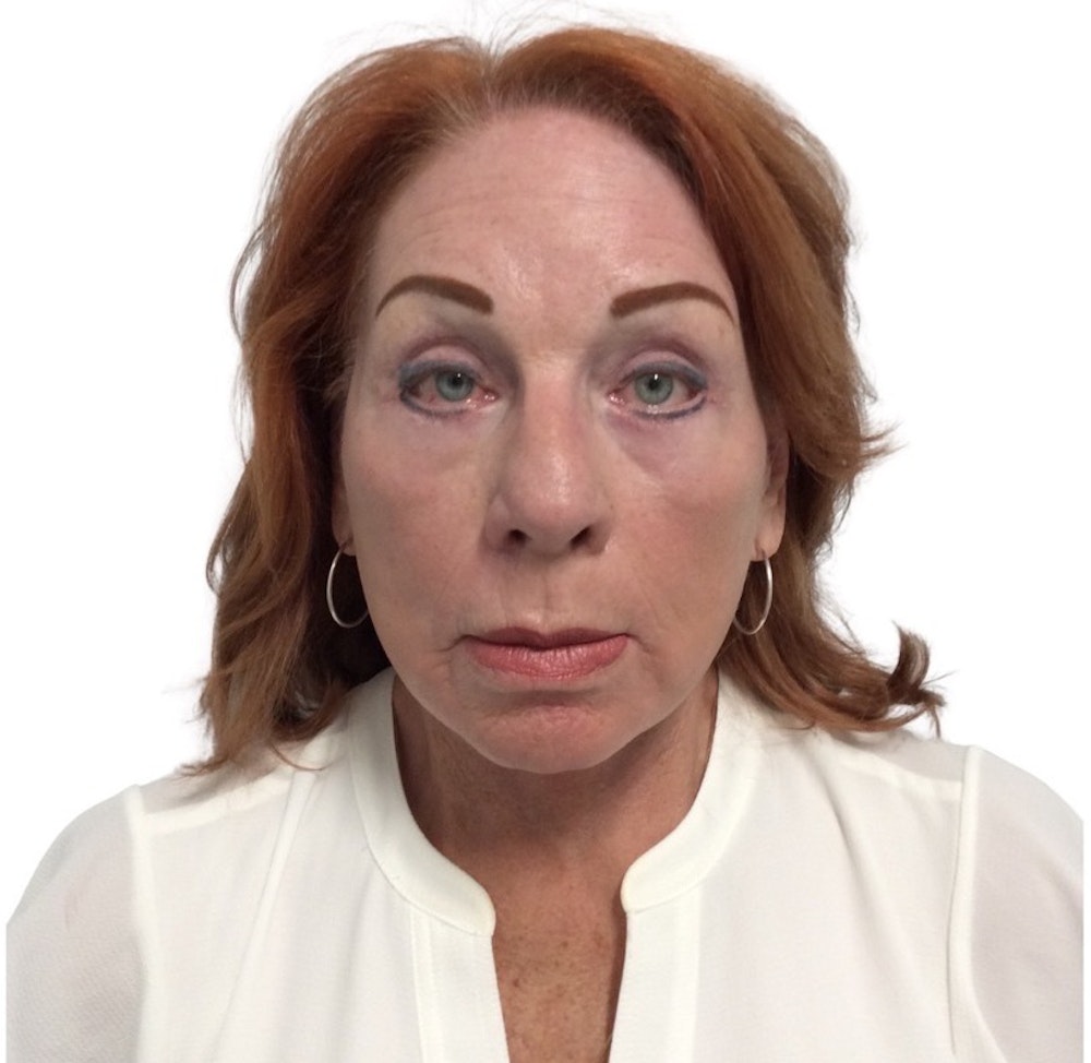 Deep Plane Facelift Before & After Gallery - Patient 13948537 - Image 2