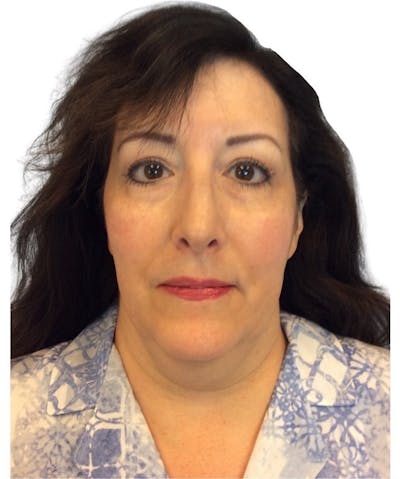 Facelift Before & After Gallery - Patient 13948538 - Image 1