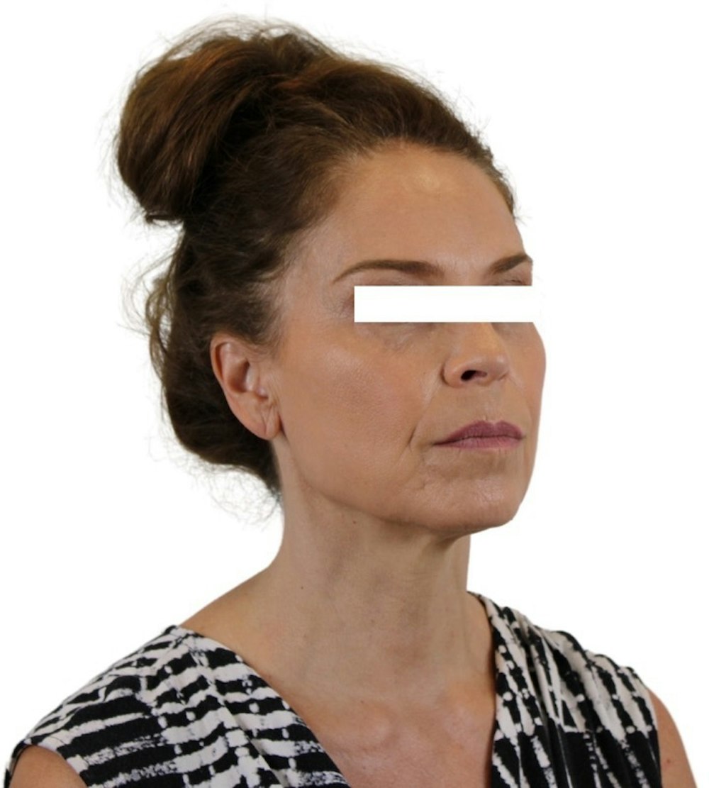 Facelift Gallery - Patient 13948536 - Image 4