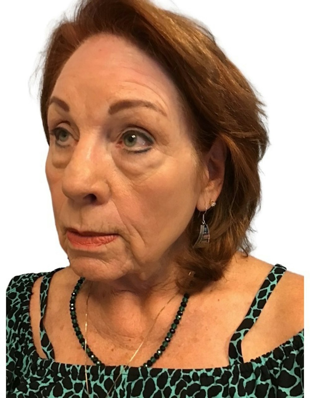 Deep Plane Facelift Before & After Gallery - Patient 13948537 - Image 3
