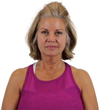 Facelift Before & After Gallery - Patient 13948539 - Image 1