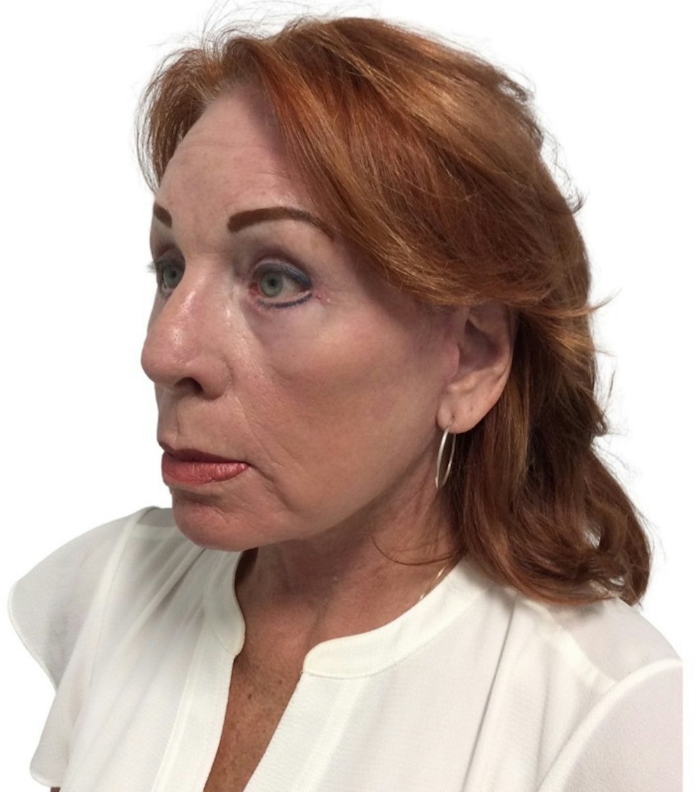Deep Plane Facelift Before & After Gallery - Patient 13948537 - Image 4