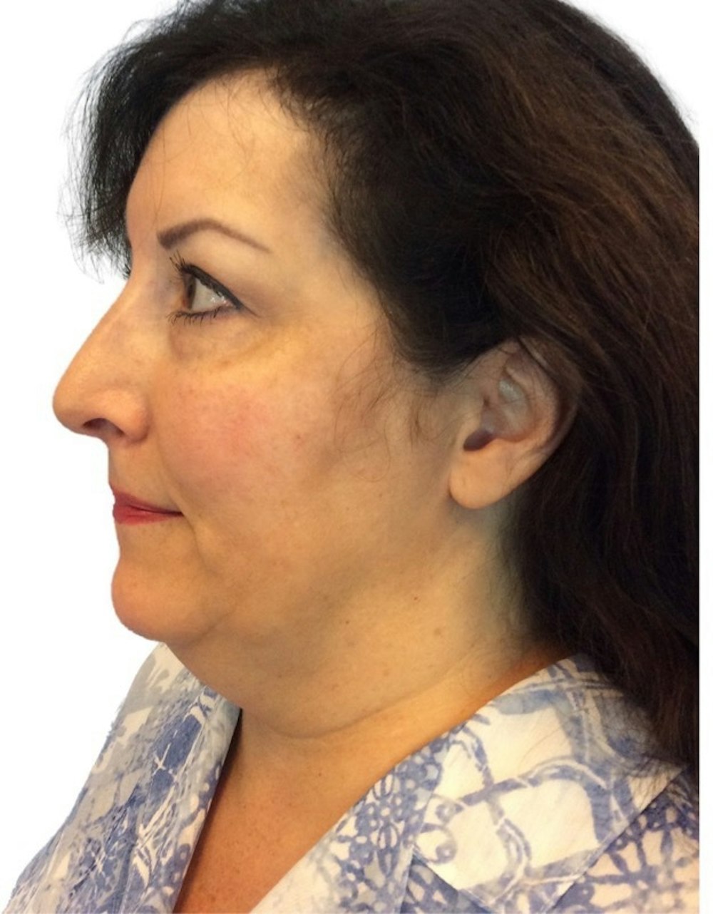 Facelift Before & After Gallery - Patient 13948538 - Image 3
