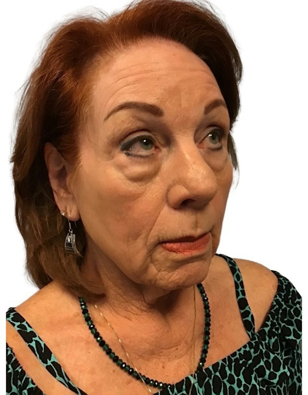 Deep Plane Facelift Before & After Gallery - Patient 13948537 - Image 5